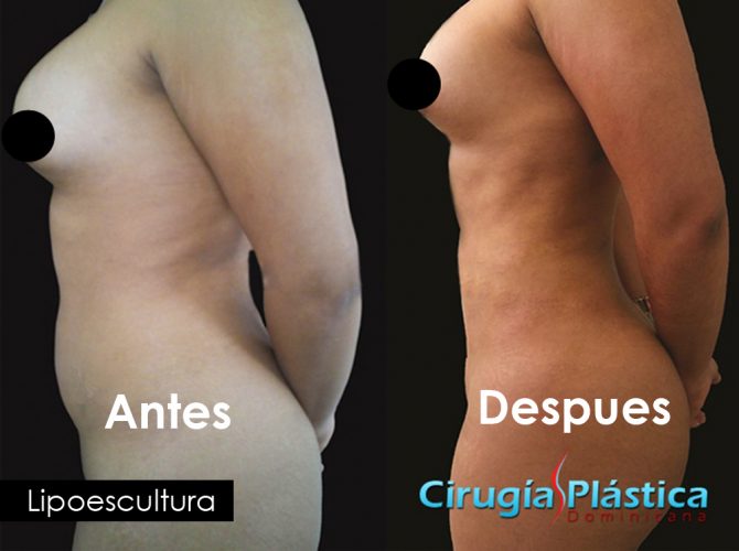 Lipoescultura_antes_y_despues_cirugia_plastica_dominicana1